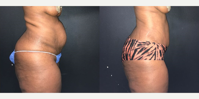 Case 1861 - Woman treated with Tummy Tuck