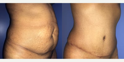 Case 1862 - 45-54 year old woman treated with Tummy Tuck