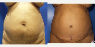 Case 1863 - 45-54 year old woman treated with Tummy Tuck