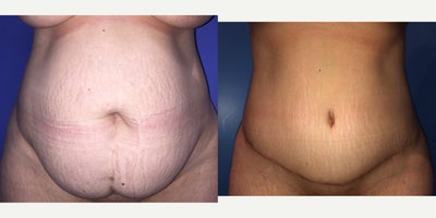 Case 1864 - 25-34 year old woman treated with Tummy Tuck