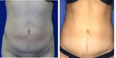Case 1865 - 35-44 year old woman treated with Tummy Tuck