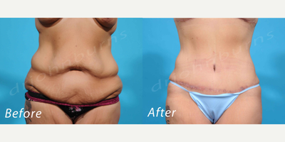 Case 1866 - 35-44 year old woman treated with Tummy Tuck