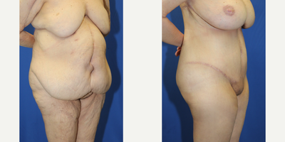 Case 1867 - 55-64 year old woman treated with Tummy Tuck