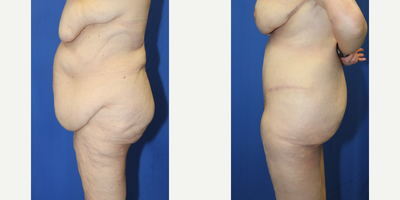 Case 1868 - 55-64 year old woman treated with Tummy Tuck