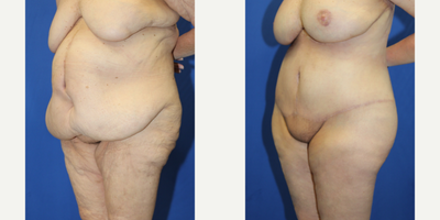 Case 1869 - 55-64 year old woman treated with Tummy Tuck