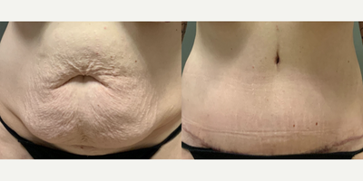 Case 187 - Woman treated with Tummy Tuck