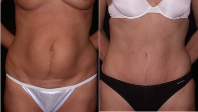Case 1870 - Woman treated with Tummy Tuck