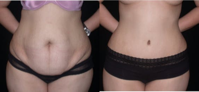 Case 1871 - Woman treated with Tummy Tuck