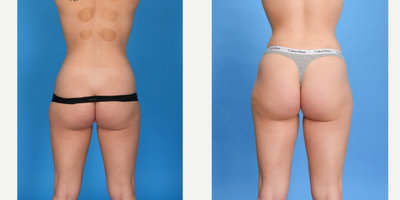 Case 1872 - 25-34 year old woman treated with Tummy Tuck