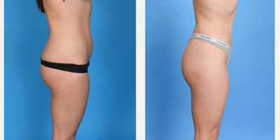 Case 1873 - 25-34 year old woman treated with Tummy Tuck