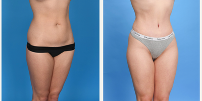 Case 1874 - 25-34 year old woman treated with Tummy Tuck