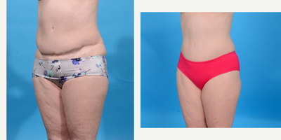 Case 1875 - 45-54 year old woman treated with Tummy Tuck 