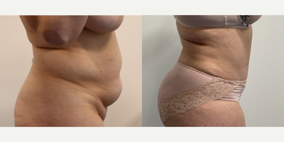 Case 1878 - 45-54 year old woman treated with Tummy Tuck, Liposuction, Umbilical Hernia Repair