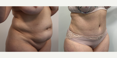 Case 1879 - 45-54 year old woman treated with Tummy Tuck, Liposuction, Umbilical Hernia Repair