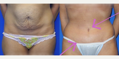 Case 188 - Woman treated with Tummy Tuck