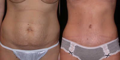 Case 1883 - Tummy Tuck