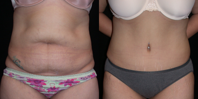 Case 1884 - Tummy Tuck