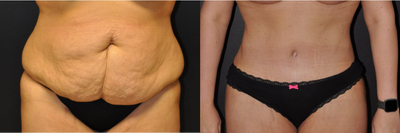 Case 1885 - 32 year old woman treated with Tummy Tuck