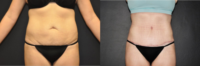 Case 1886 - 34 year old woman treated with Tummy Tuck