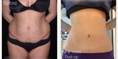 Case 189 - Woman treated with Tummy Tuck