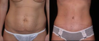 Case 1891 - Woman treated with Tummy Tuck