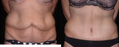 Case 1892 - Woman treated with Tummy Tuck