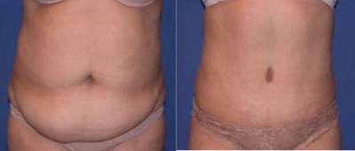 Case 1893 - Woman treated with Tummy Tuck