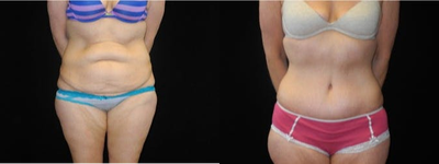 Case 1894 - Woman treated with Tummy Tuck