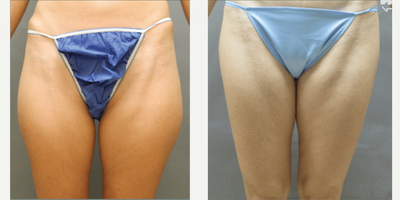 Case 1895 - Woman treated with Tummy Tuck