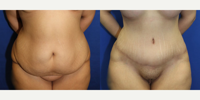 Case 19 - Woman treated with Tummy Tuck