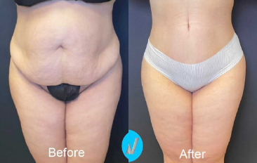 Case 190 - Woman treated with Tummy Tuck