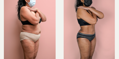 Case 1900 - 55-64 year old woman treated with Liposuction, Tummy Tuck