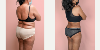 Case 1901 - 55-64 year old woman treated with Liposuction, Tummy Tuck