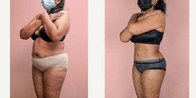 Case 1902 - 55-64 year old woman treated with Tummy Tuck