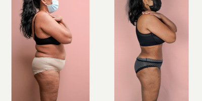 Case 1903 - 55-64 year old woman treated with Tummy Tuck