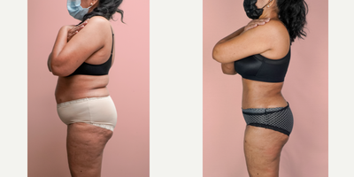 Case 1905 - 55-64 year old woman treated with Tummy Tuck