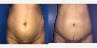 Case 1906 - 35-44 year old woman treated with Tummy Tuck