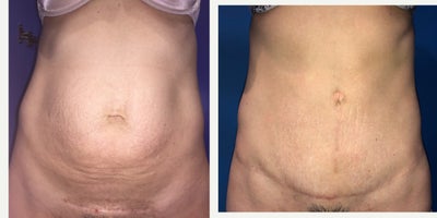 Case 1907 - 35-44 year old woman treated with Tummy Tuck