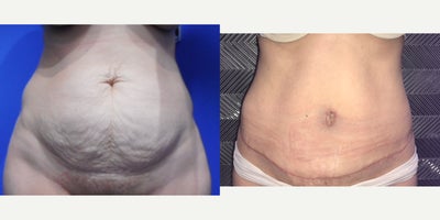 Case 1908 - 45-54 year old woman treated with Tummy Tuck