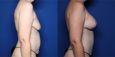 Case 1915 - 35-44 year old woman treated with Mommy Makeover, Breast Lift with Implants, Natrelle Breast Implants, Tummy Tuck