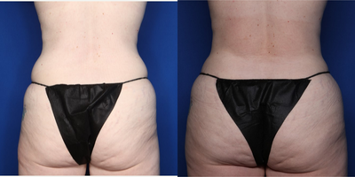 Case 1916 - 35-44 year old woman treated with Mommy Makeover, Breast Lift with Implants, Natrelle Breast Implants, Tummy Tuck