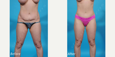 Case 1919 - 35-44 year old woman treated with Tummy Tuck