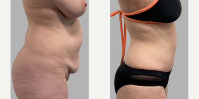 Case 1925 - 45-54 year old woman treated with Tummy Tuck