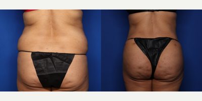 Case 1926 - 35-44 year old woman treated with Tummy Tuck