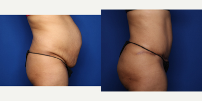 Case 1927 - 35-44 year old woman treated with Tummy Tuck
