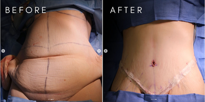 Case 193 - Woman treated with Body Lift, Tummy Tuck