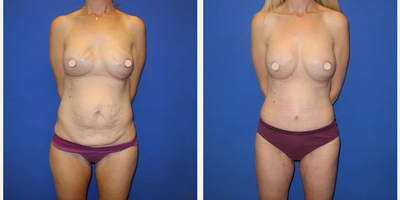 Case 194 - Woman treated with Tummy Tuck, Breast Fat Transfer, Breast Implant Revision