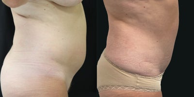 Case 1944 - 45-54 year old woman treated with Tummy Tuck, Breast Reduction