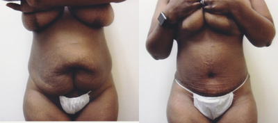 Case 1945 - 25-34 year old woman treated with Tummy Tuck