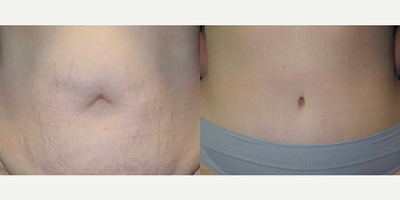 Case 195 - Woman treated with Tummy Tuck